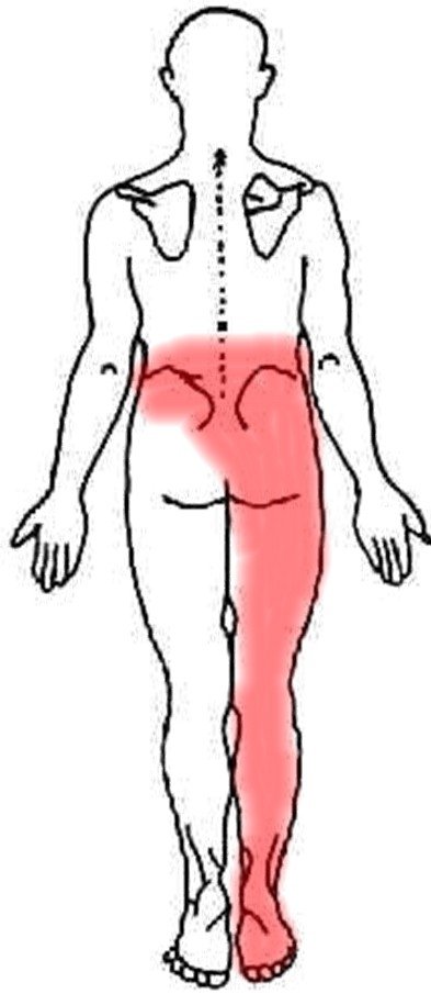 sciatic-nerve-pain